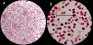 <p><b>Fig. 67:4.</b> Gram staining of <i>Moraxella bovis</i>, strain BKT 14841/10. The arrows indicate bacteria that appear in pairs (common). The field B is a partial magnification (6 times) of A. The lengths of the scale bars corresponds to 5 µm. Date: 2011-03-24.</p>

<p> </p>